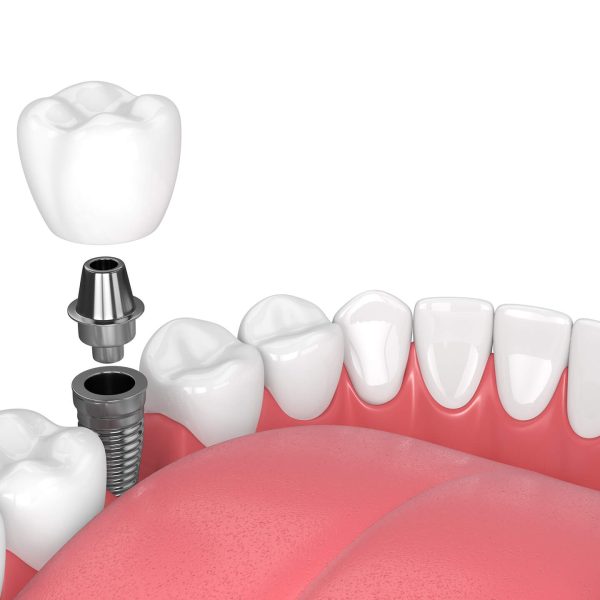 Dental Implants